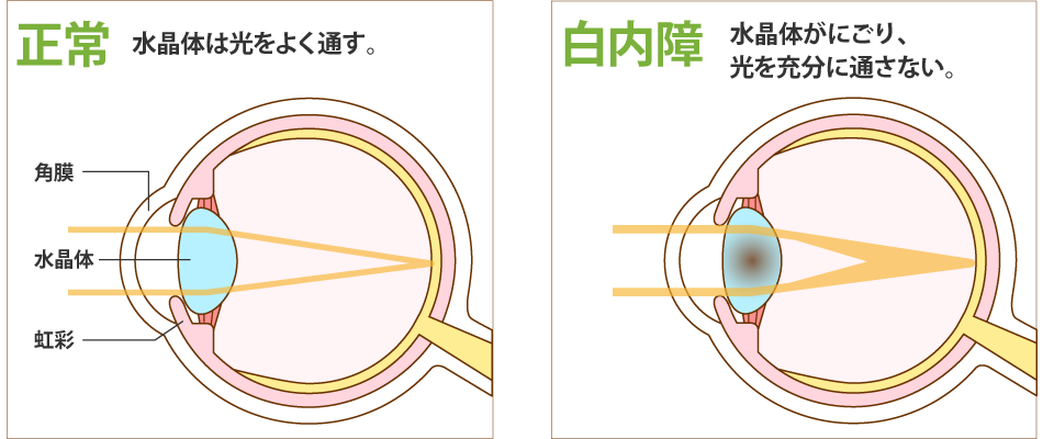 白内障とは